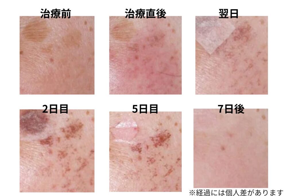 光治療(ライムライト)