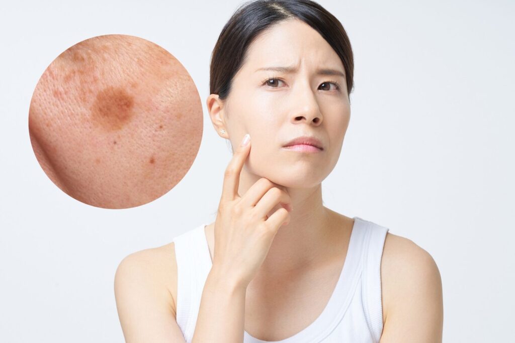 シミは自然に消える？消えない理由と肌の仕組みを解説