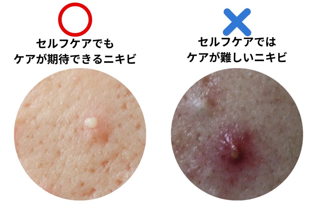 セルフケアでできる範囲と限界