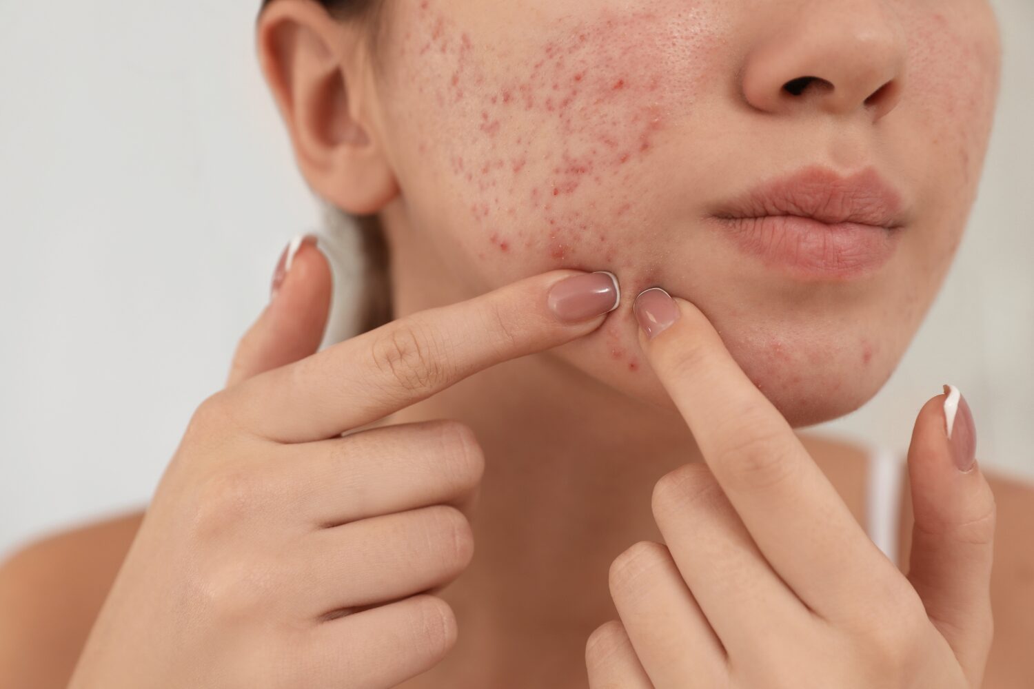 急にニキビが増えた…考えられる原因と正しい治し方