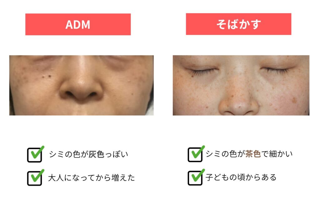 発症年齢・色・層の違い