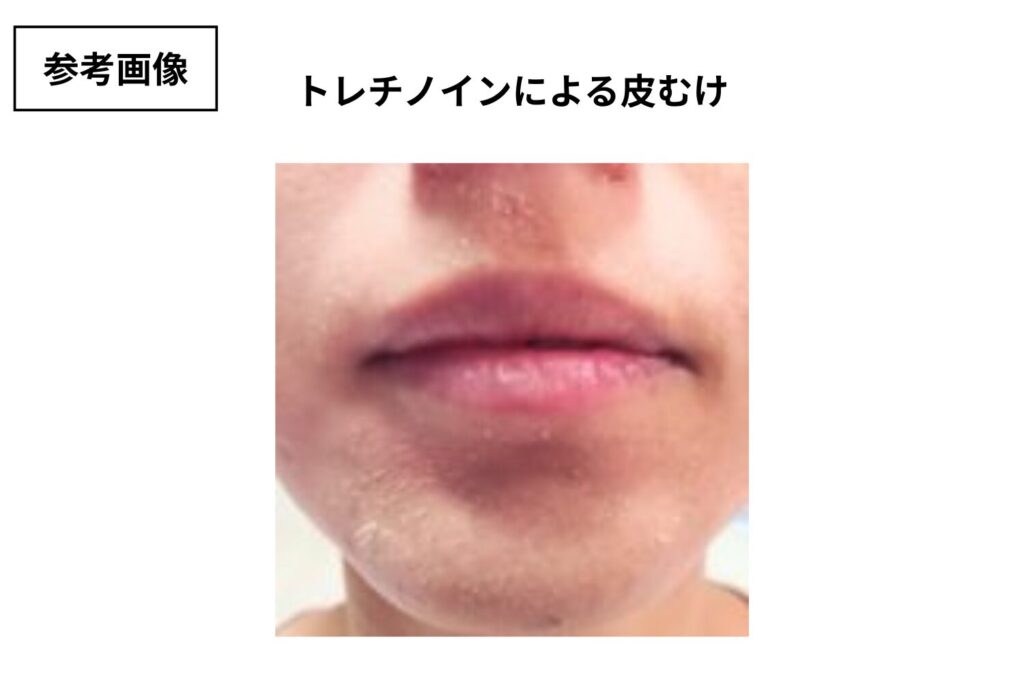 A反応はトレチノインが効いているサイン