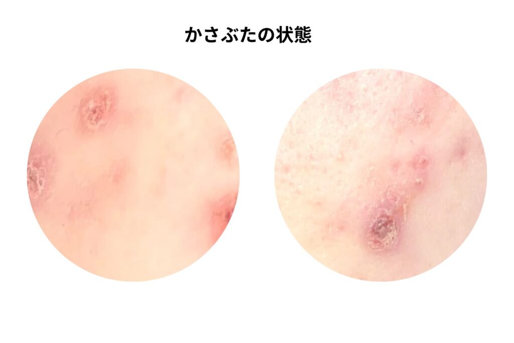 かさぶたや一時的な変色の可能性