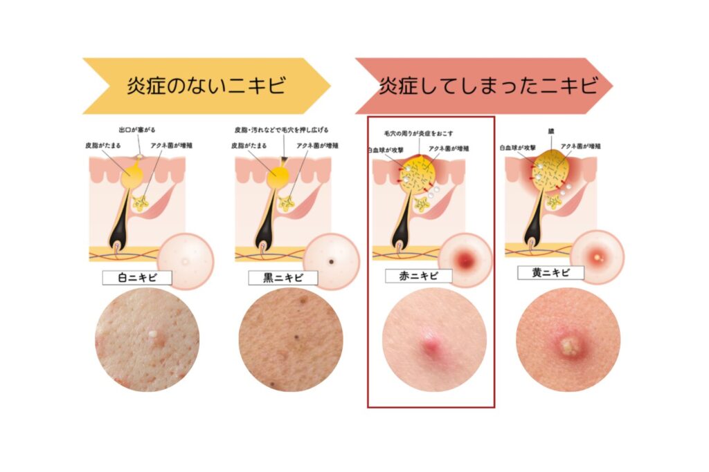 白ニキビ・黒ニキビとの違い