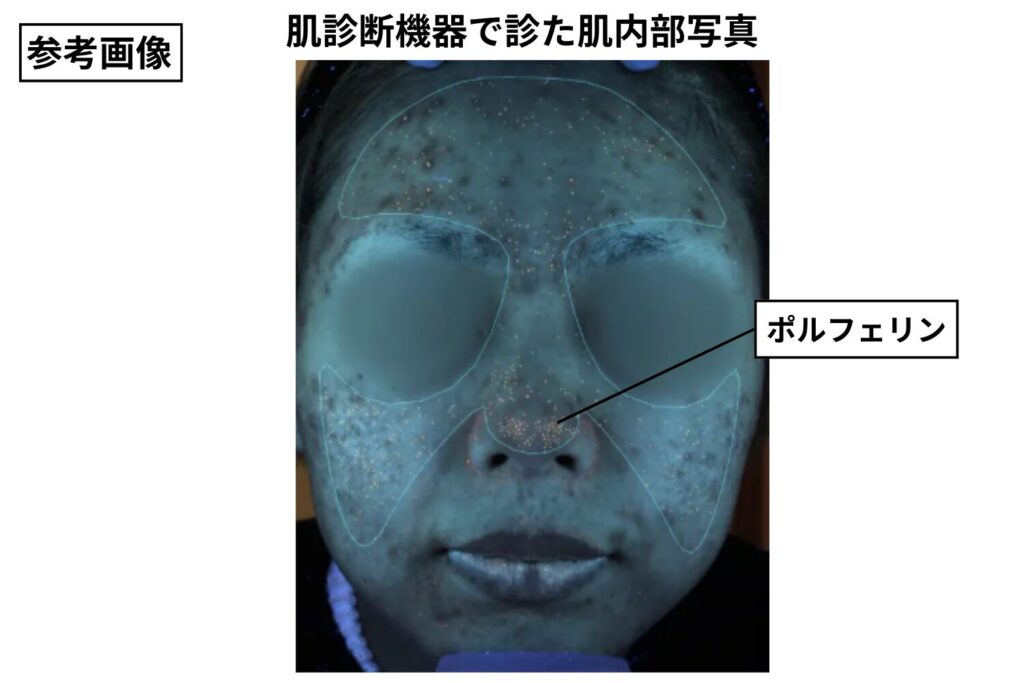 アクネ菌の増殖