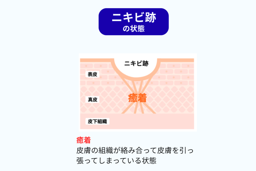 真皮までダメージが及ぶと凹凸が残る