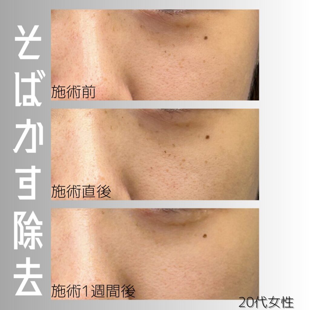 アキュチップの症例画像