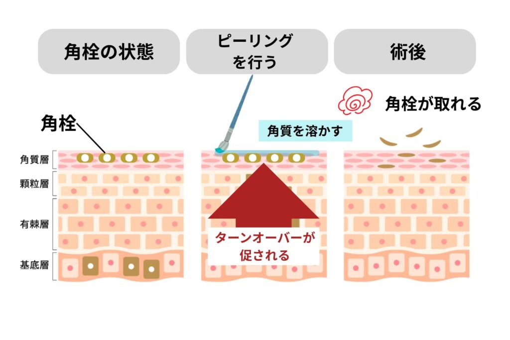 ケミカルピーリング