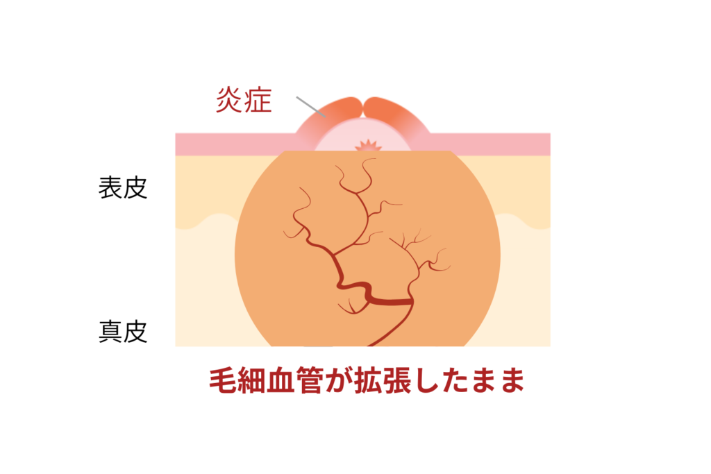 赤みタイプは「刺激を減らすケア」が最優先