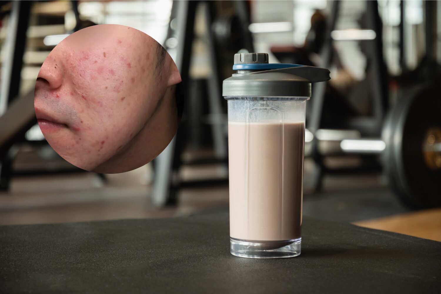 プロテインでニキビができる理由と正しい選び方