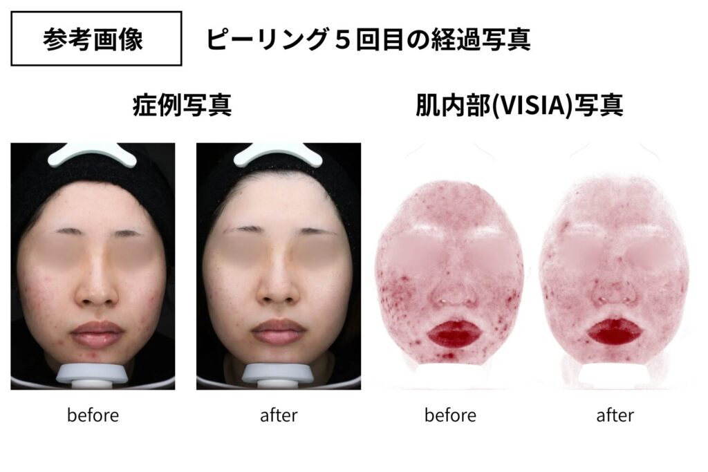 ケミカルピーリングで期待できる効果と実感の目安