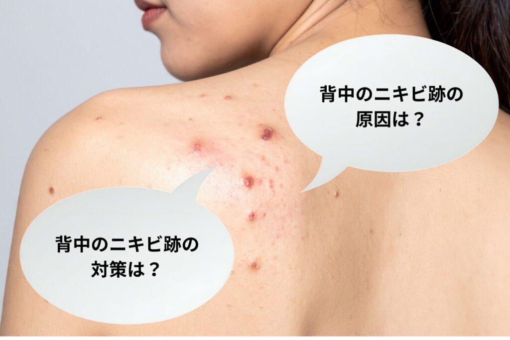 背中のニキビ跡が消えない原因と対策｜タイプ別ケアと受診目安