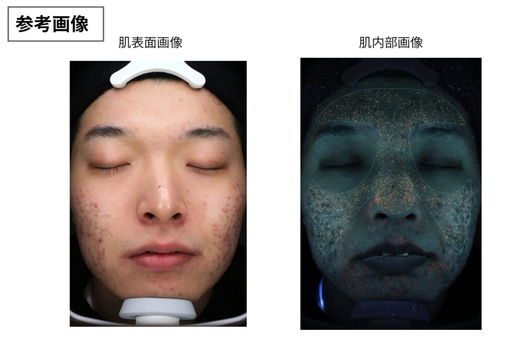 角栓はアクネ菌が増える環境を作る