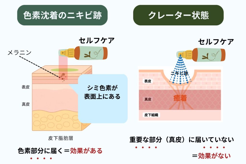 自力で消せる跡と消せない跡の違い