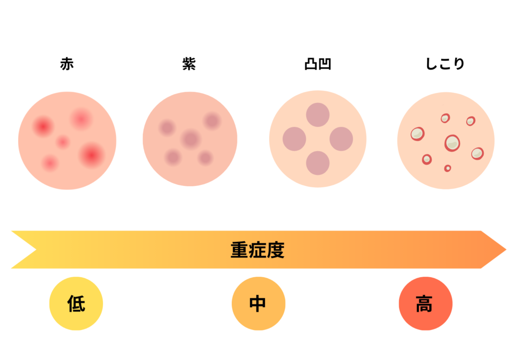 ニキビ跡の種類は主に4つ