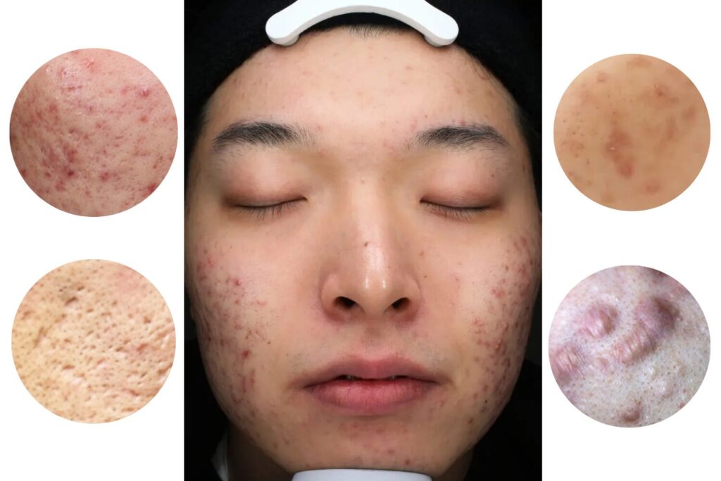 ニキビ跡の種類を見分ける方法！治し方の選び方