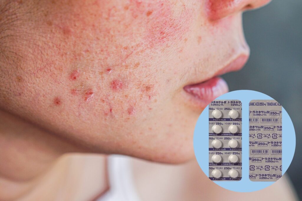 ニキビにトラネキサム酸は効く？