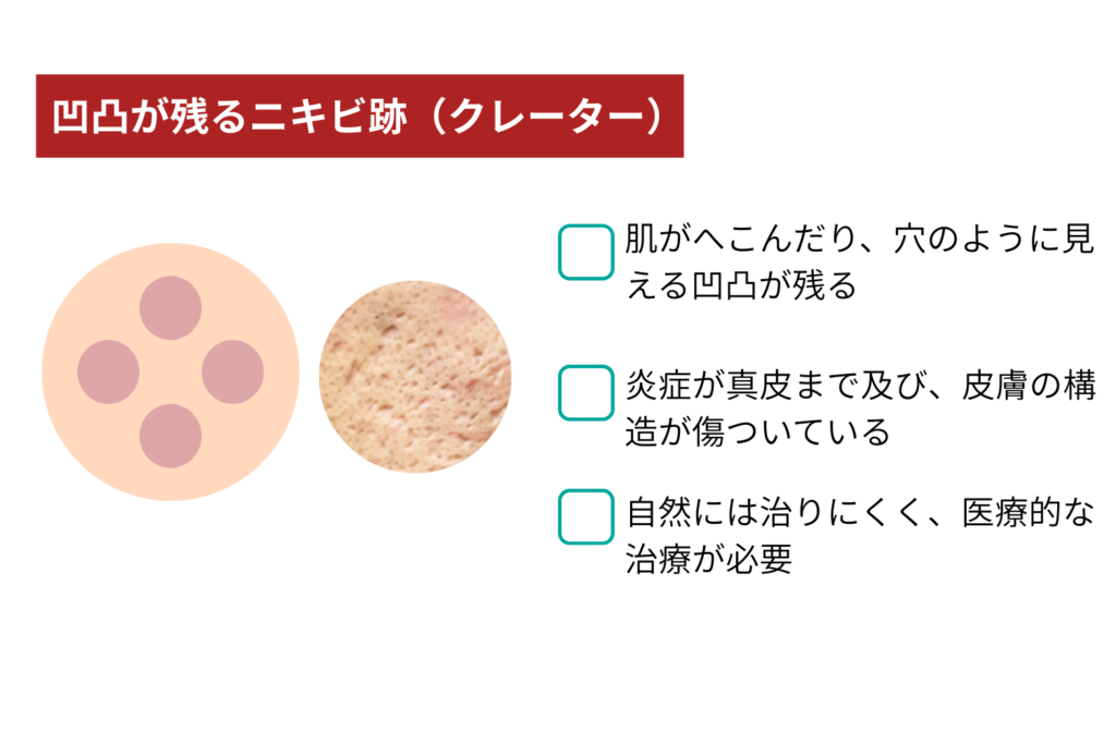 凹凸が残るニキビ跡(クレーター)
