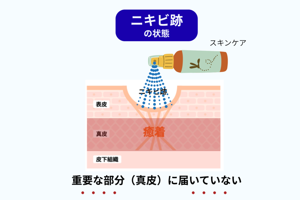セルフケアで改善しにくい理由