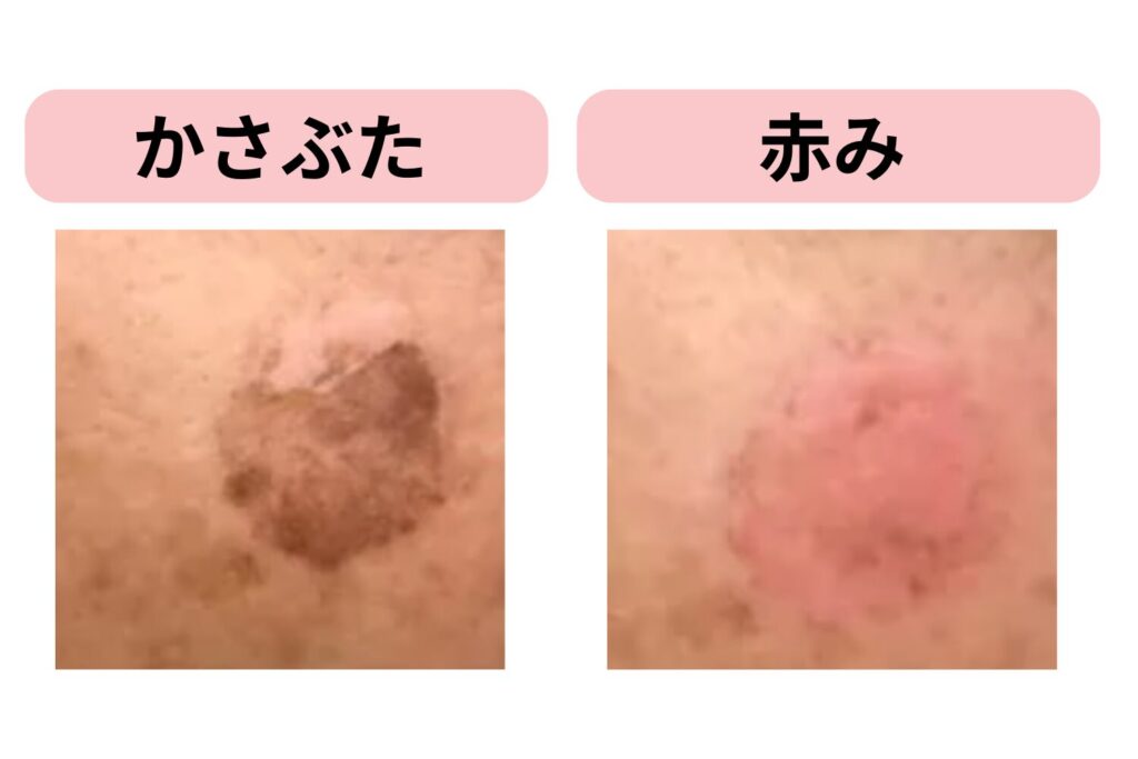 ダウンタイムは約2週間が目安