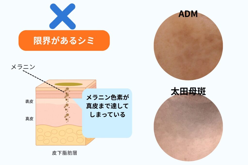 シミ取りクリームでは限界があるシミ・アザ