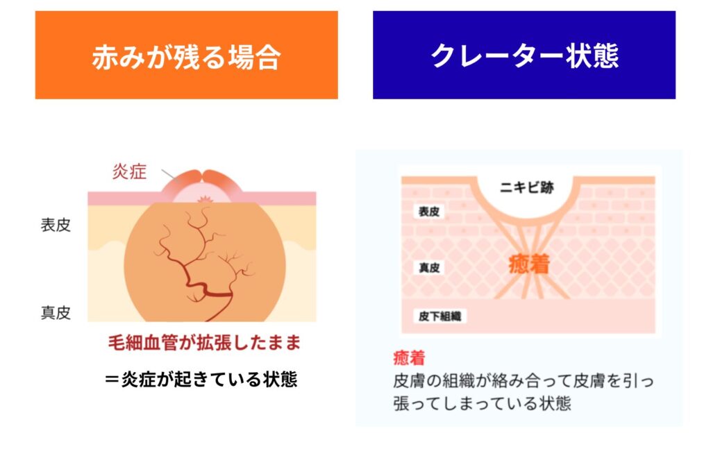 赤み跡やクレーターとの違い