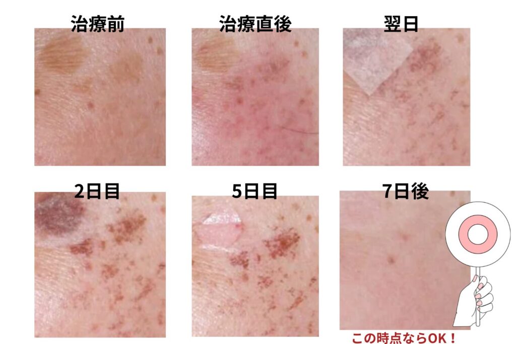 シミ取りダウンタイムの経過と肌状態の変化