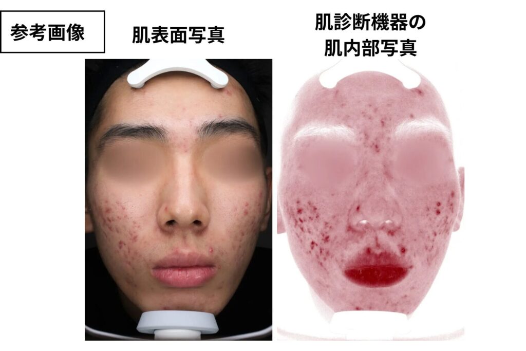 放置すると炎症やニキビ跡につながりやすい