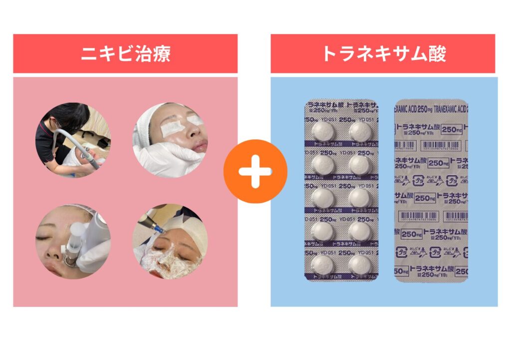 ニキビ跡を残さないために併用する考え方