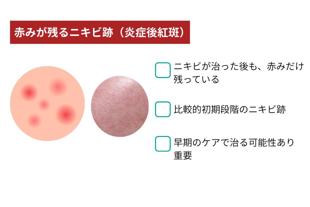 赤みが残るニキビ跡(炎症後紅斑)