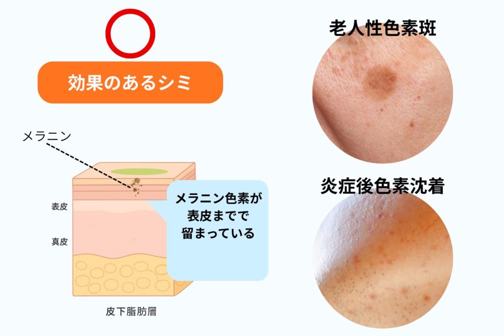 効果が期待できるシミ｜表皮にメラニンがあるタイプ