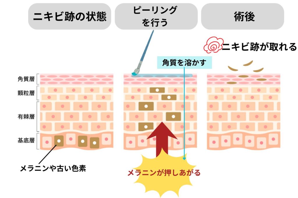 薄くなる仕組み