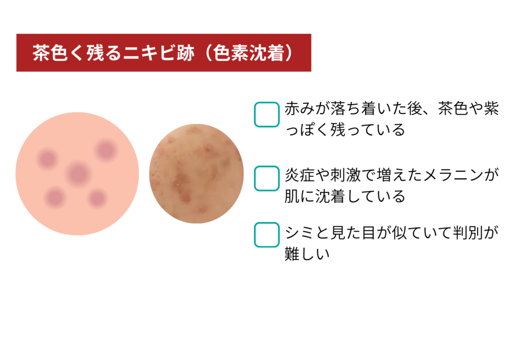 茶色く残るニキビ跡(色素沈着)