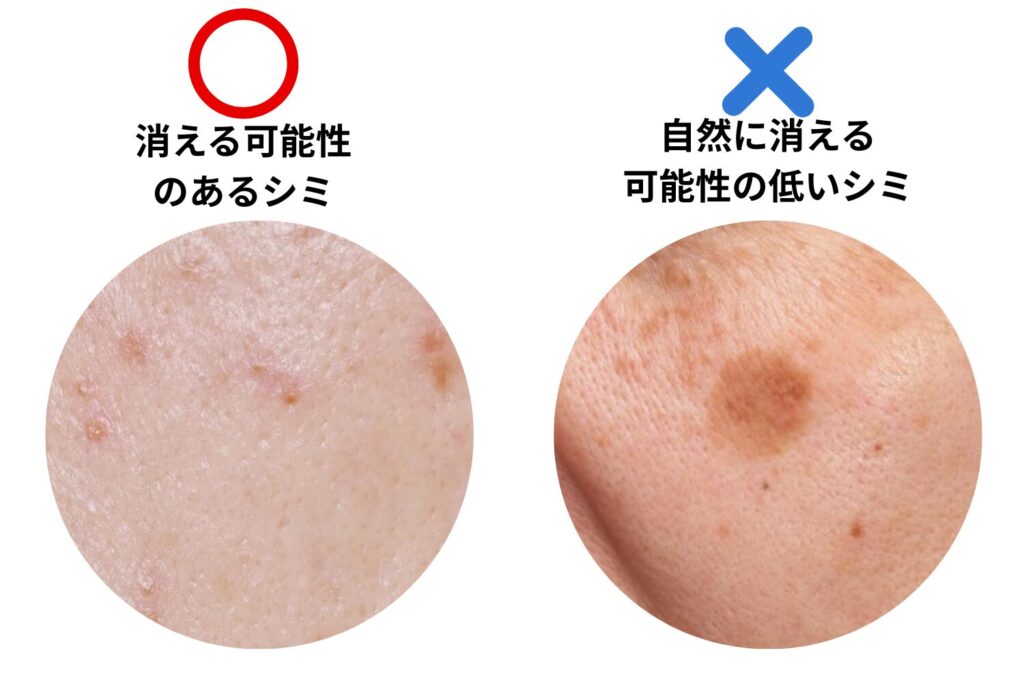 自然に薄くなるケースは一部に限られる