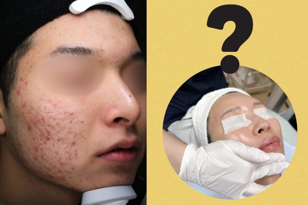 ケミカルピーリングでニキビ跡は消える？回数・効果・注意点を解...