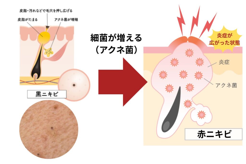 赤いニキビの基本的な状態