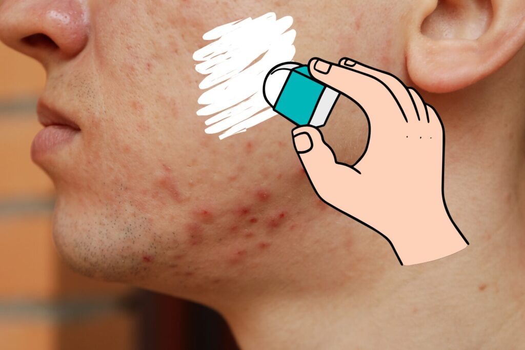 ニキビ跡の消し方を種類別に解説｜赤み・色素沈着・凹み・しこり