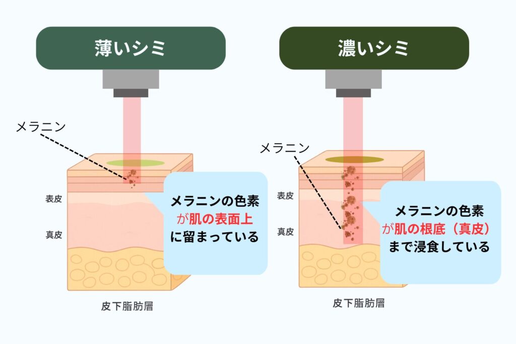 シミの濃さや深さで回復期間が変わる