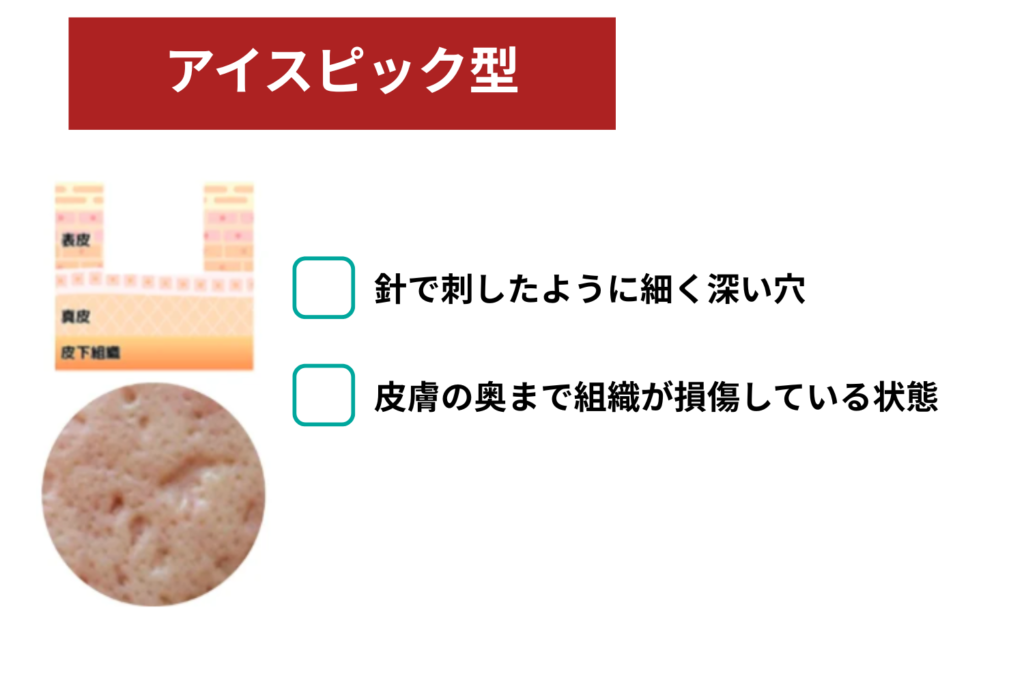 アイスピック型