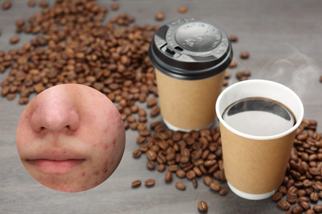 ニキビとコーヒーの関係を整理|悪化する飲み方と対策