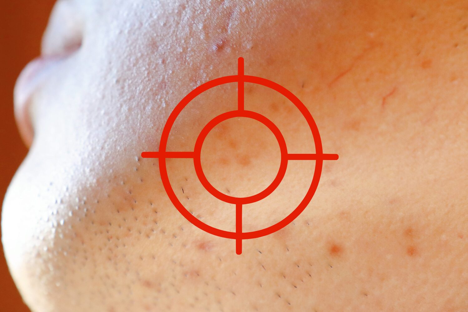 ニキビ跡が黒くなる原因は？色素沈着の対策と治し方