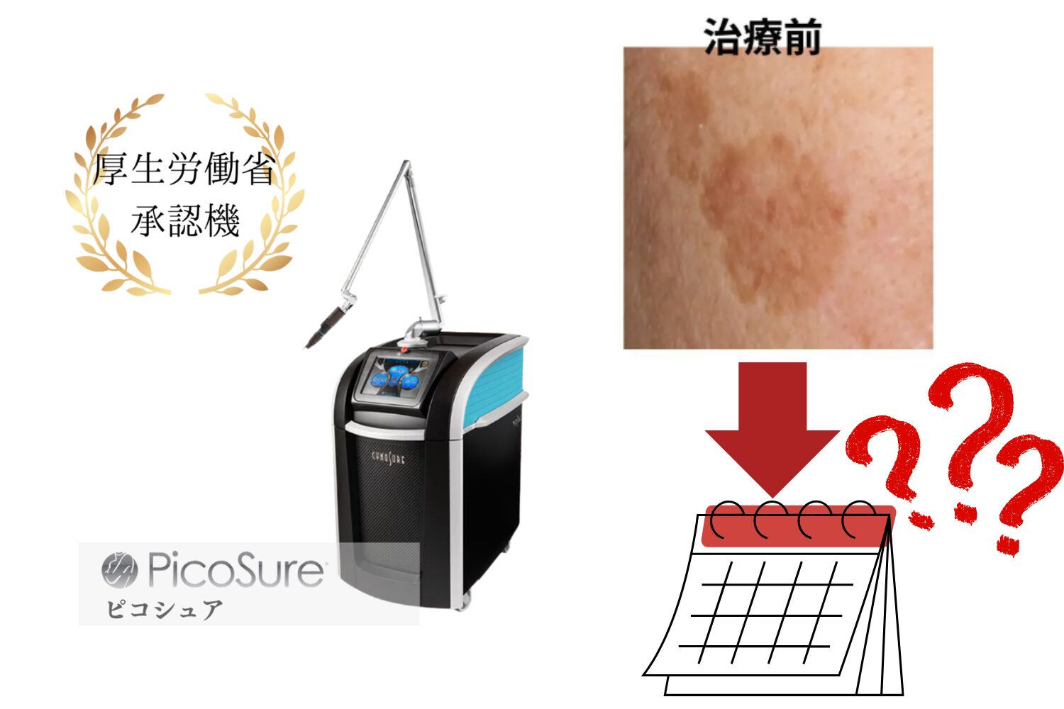 ピコスポットのダウンタイムは何日?経過と注意点