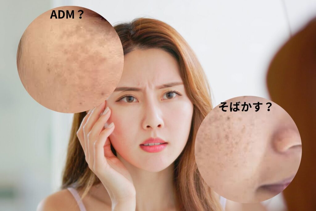 ADMとそばかすの違いを見分けるコツ｜治療の流れ
