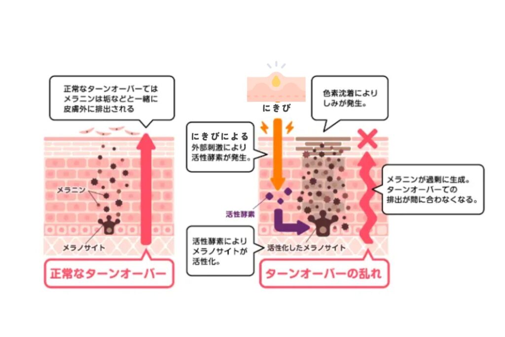 炎症後色素沈着が起こる仕組み