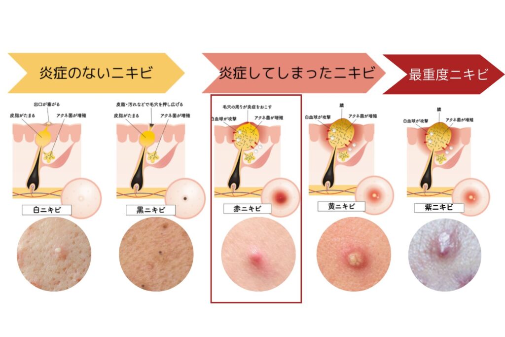 赤いニキビは炎症が進行しているサイン