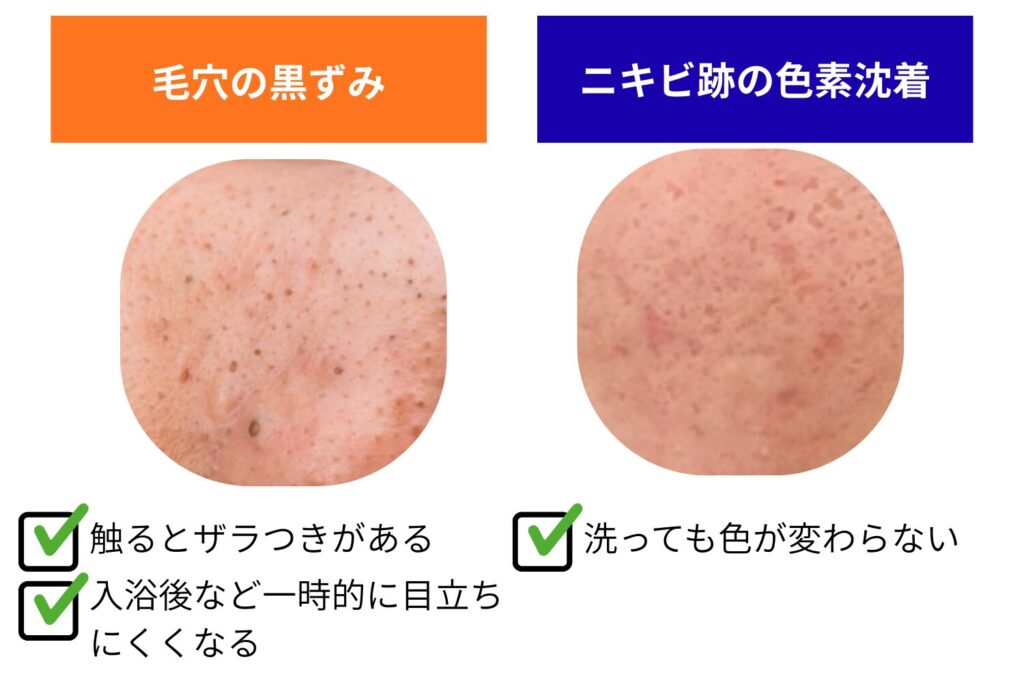 毛穴の黒ずみとの見分け方