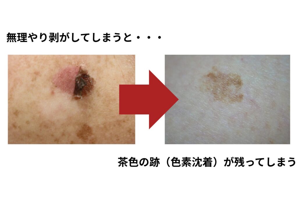 無理に剥がすとどうなる?