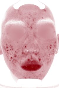 ニキビビフォー