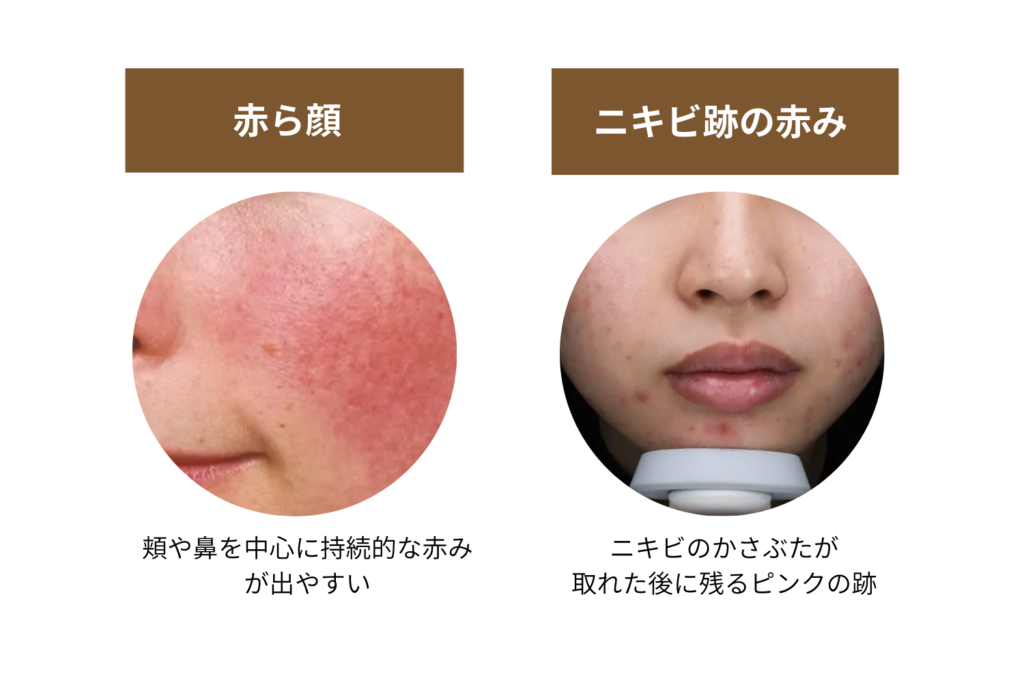 赤ら顔・ニキビ跡の赤み