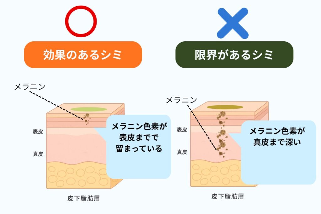 効果が期待できるシミと限界があるシミがある